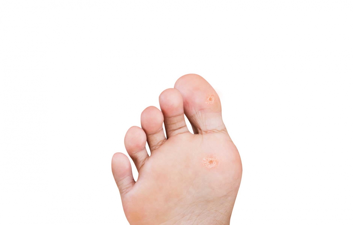 Warts and Foot Surgery – Damien Lafferty