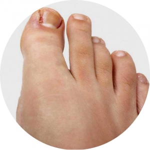 Ingrown Toenails