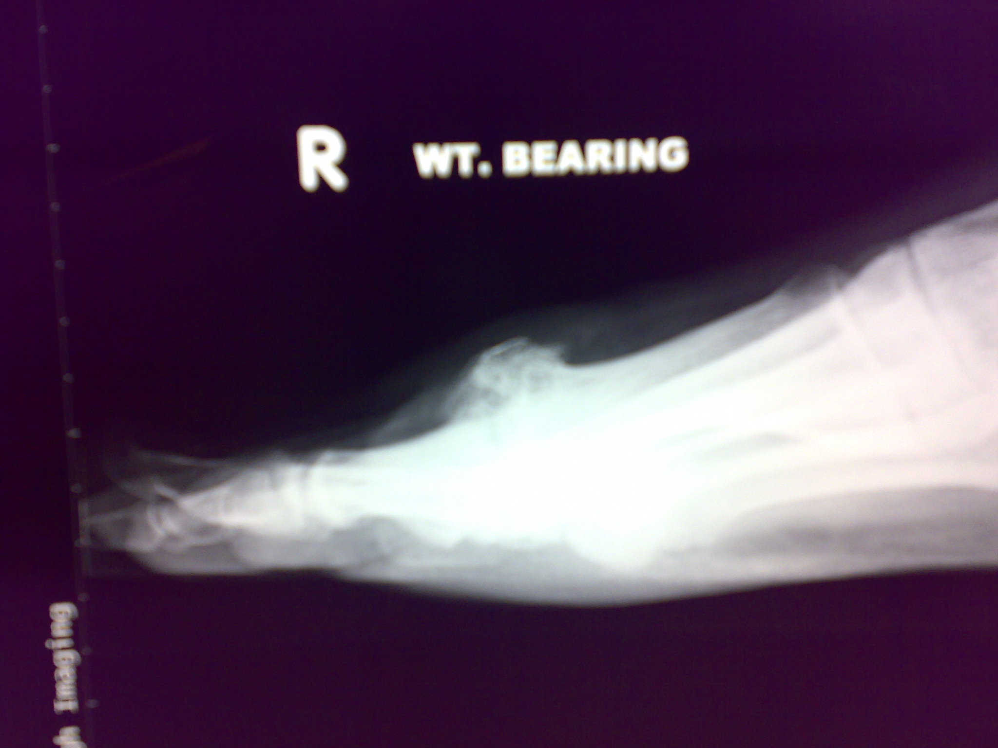 Big Toe Arthritis – After After