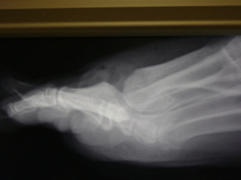 Big Toe Arthritis – Before Before