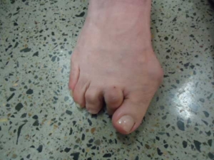 Hammer Toe Surgery and Comprehensive Treatment