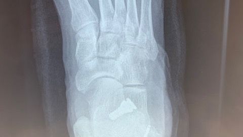 Hyperpronation cure Hyperpronation cure