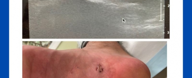 Chronic heel pain Chronic heel pain