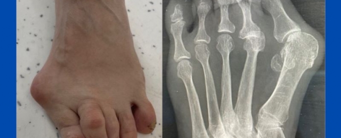 Dislocated 2nd MTPJ Dislocated 2nd MTPJ