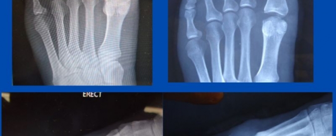 Motion following hallux limitus surgery Motion following hallux limitus surgery