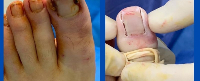 Hypergranulation tissue Hypergranulation tissue