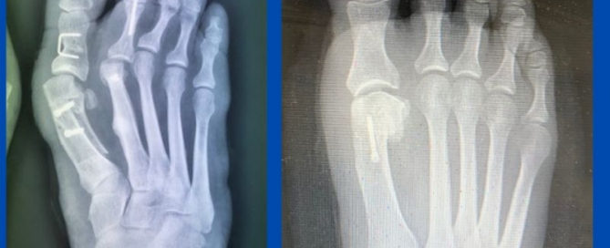 Improvements in bunion surgery Improvements in bunion surgery