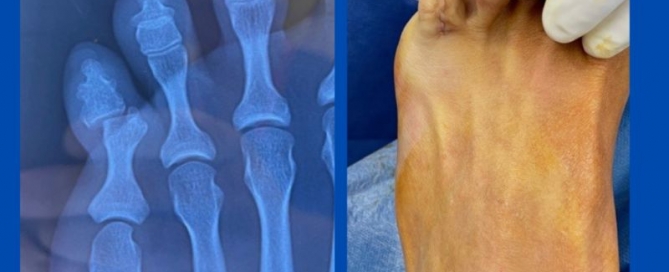 Interdigital corn Interdigital corn