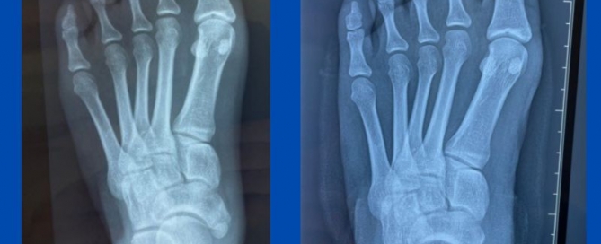 Accessory navicular with pes planus Accessory navicular with pes planus