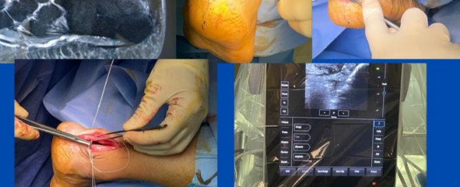 Platelet Rich Plasma (PRP) Platelet Rich Plasma (PRP)