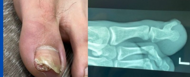Subungual exostosis Subungual exostosis