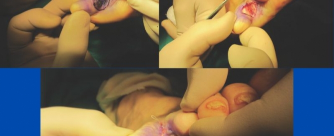 Heloma molle/soft corn Heloma molle/soft corn