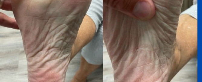 Plantar fasciotomy post-op Plantar fasciotomy post-op