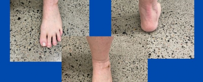 Post-operative pes planus/flat feet/excess pronation Post-operative pes planus/flat feet/excess pronation