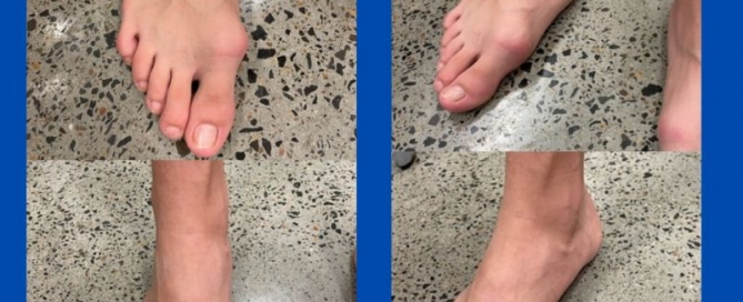 Biomechanics of a pathology (bunions and pes planus) Biomechanics of a pathology (bunions and pes planus)