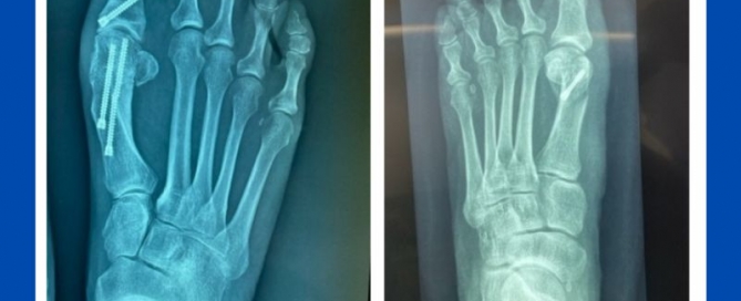 The problems with keyhole bunion surgery The problems with keyhole bunion surgery