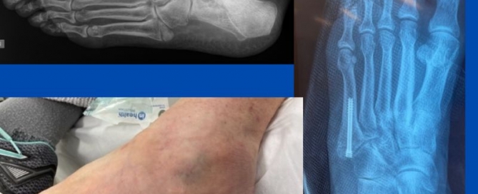 Minimally invasive fracture fixation Minimally invasive fracture fixation