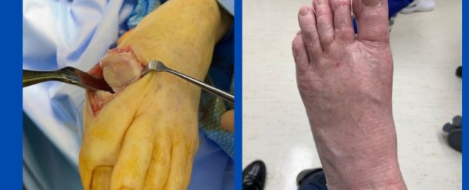 Post-operative wounds Post-operative wounds