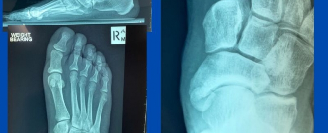 Is it posterior tibial tendon dysfunction? Is it posterior tibial tendon dysfunction?