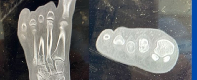 Freiberg’s Disease/Infraction Freiberg’s Disease/Infraction