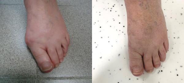 Bunion surgery: Modern procedures for quick recuperation and long-term results Bunion surgery: Modern procedures for quick recuperation and long-term results