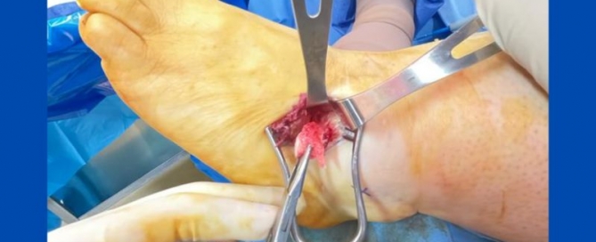 Calcaneonavicular coalition Calcaneonavicular coalition