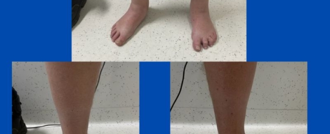 Adult-acquired flat foot (PTTD) Adult-acquired flat foot (PTTD)
