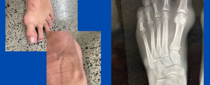 Gout deposits (not bunions) Gout deposits (not bunions)