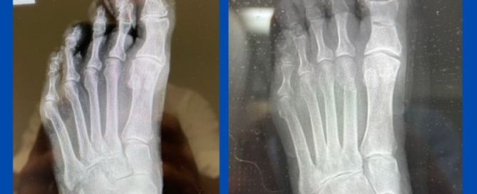 Minimally invasive forefoot reconstruction Minimally invasive forefoot reconstruction