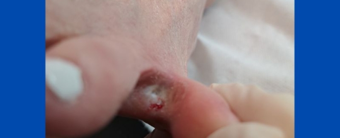 Heloma Molle (interdigital corn) Heloma Molle (interdigital corn)