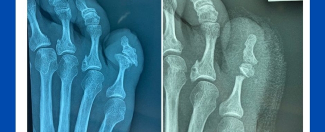 Interdigital ulcer success Interdigital ulcer success