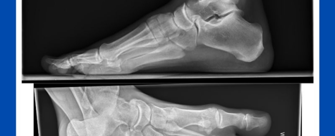 Tarsal coalition Tarsal coalition