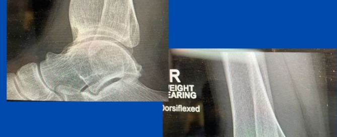 Anterior Ankle Impingement Syndrome Anterior Ankle Impingement Syndrome