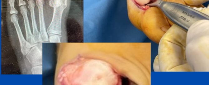 1st MTPJ cartilage damage 1st MTPJ cartilage damage