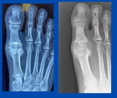 x-ray images of two feet; photos by Sydney Foot and Ankle Surgeon Damien Lafferty