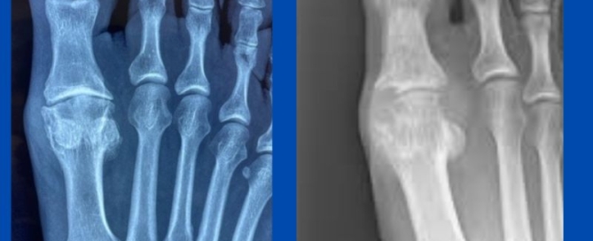 Gout or degenerative osteoarthrosis/hallux limitus? Gout or degenerative osteoarthrosis/hallux limitus?