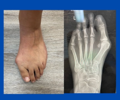 photo and x-ray of a foot with bunion; photos by Sydney Foot and Ankle Surgeon Damien Lafferty