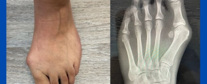 Juvenile hallux valgus (bunion) Juvenile hallux valgus (bunion)