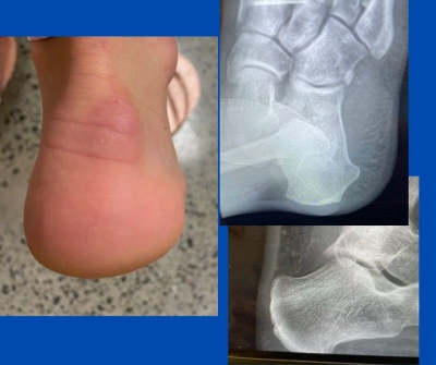 photo and x-ray images of a heel; photos by Sydney Foot and Ankle Surgeon Damien Lafferty