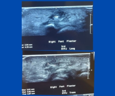 ultrasound images; photos by Sydney Foot and Ankle Surgeon Damien Lafferty