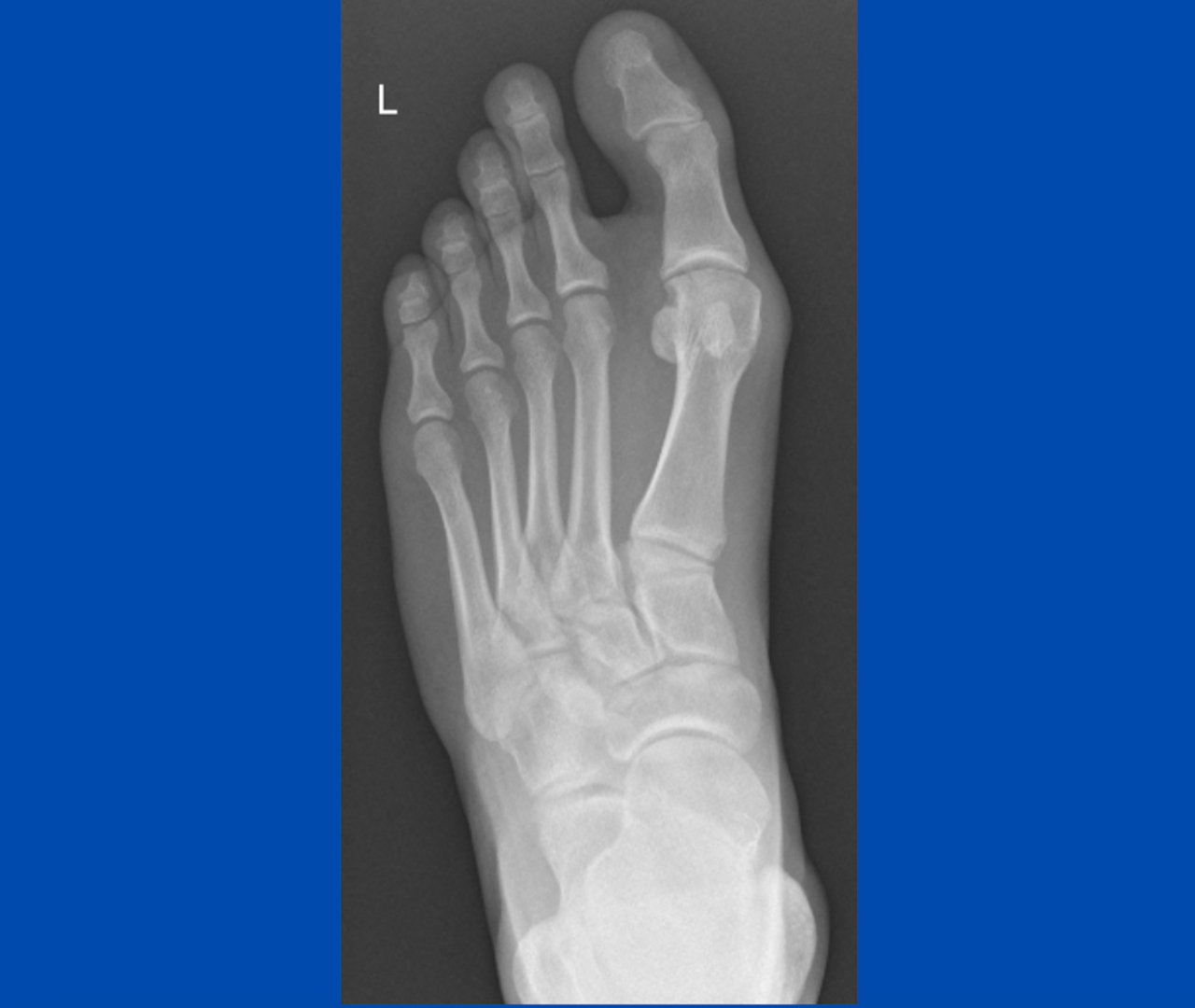 foot x-ray; photo by Sydney Foot and Ankle Surgeon Damien Lafferty