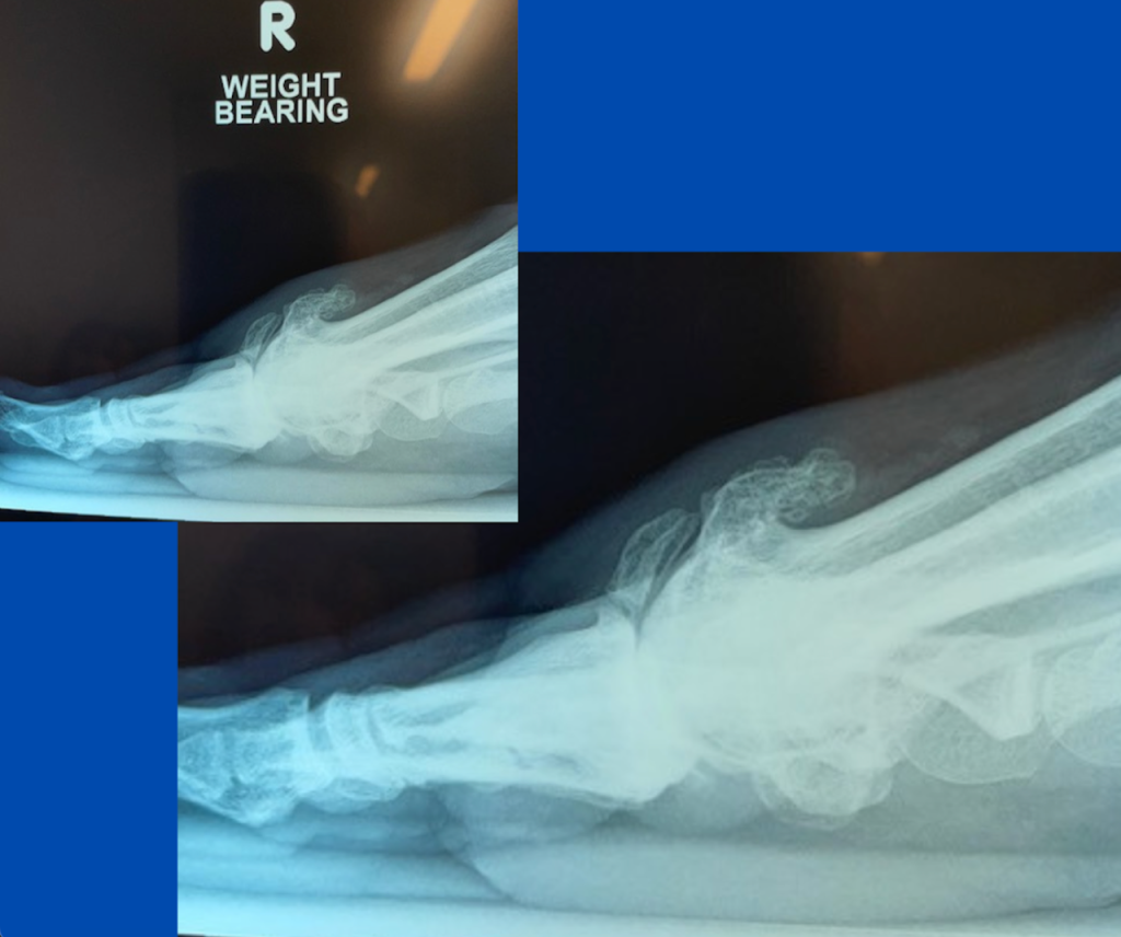 Fractured bone spur