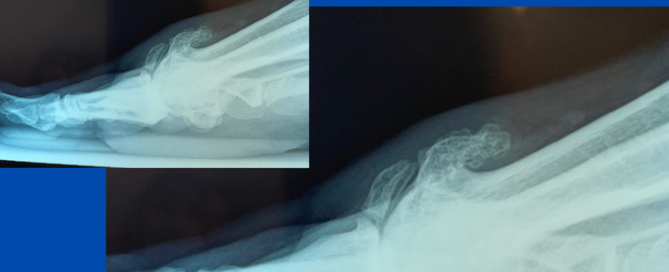 Fractured bone spur Fractured bone spur