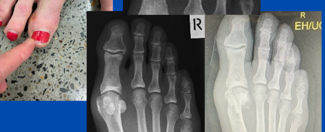 Minimally-invasive surgery (bunion and lateral hallux IPJ) Minimally-invasive surgery (bunion and lateral hallux IPJ)