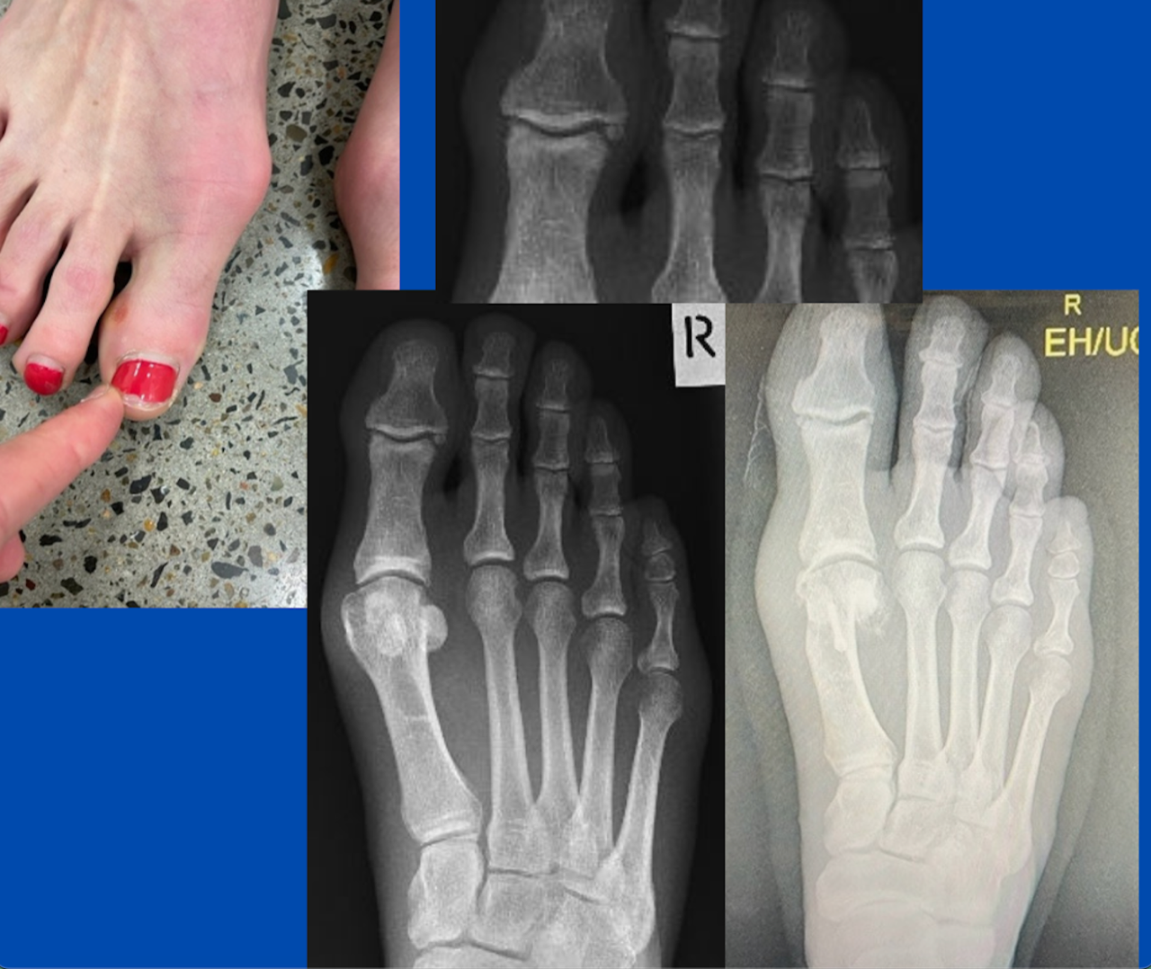 foot x-rays and photo; photo by Sydney Foot and Ankle Surgeon Damien Lafferty