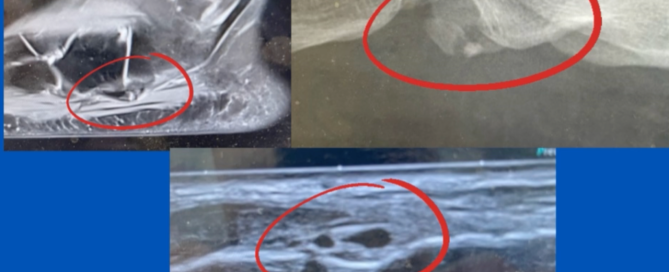 Bipartite Os Peroneum Bipartite Os Peroneum