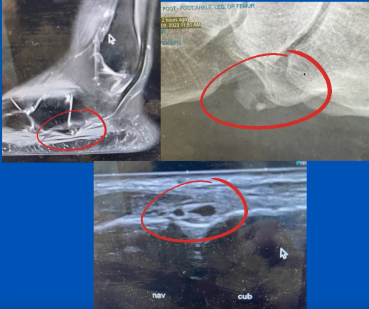 images of foot with Os Peroneum; image by Sydney Foot and Ankle Surgeon Damien Lafferty