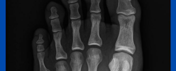 Subungual exostoses Subungual exostoses