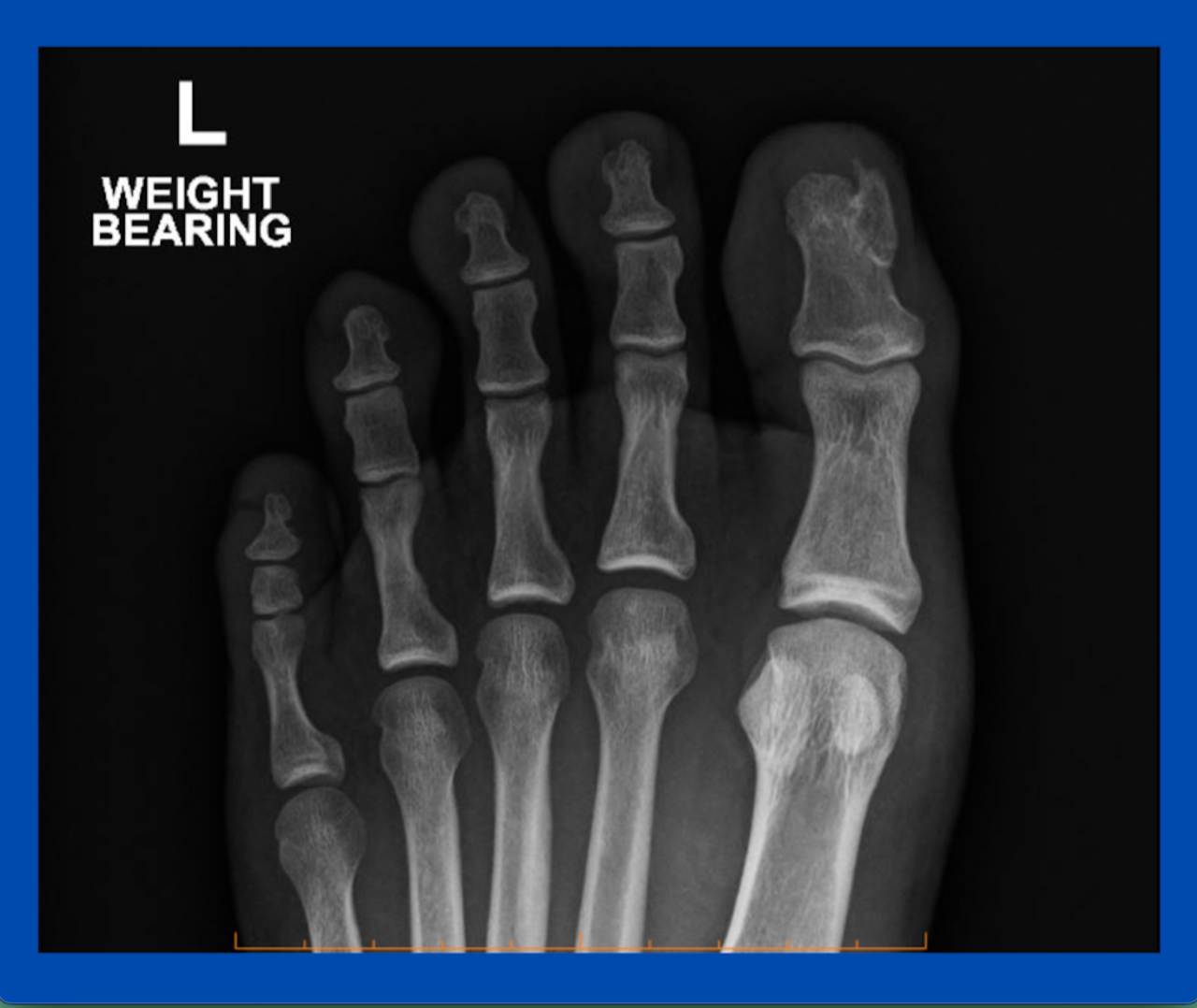 X-ray of foot with subungual exostosis; image by Sydney Foot and Ankle Surgeon Damien Lafferty