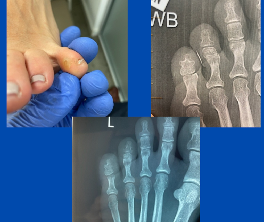 Ankylosed DIPJ and interdigital corn